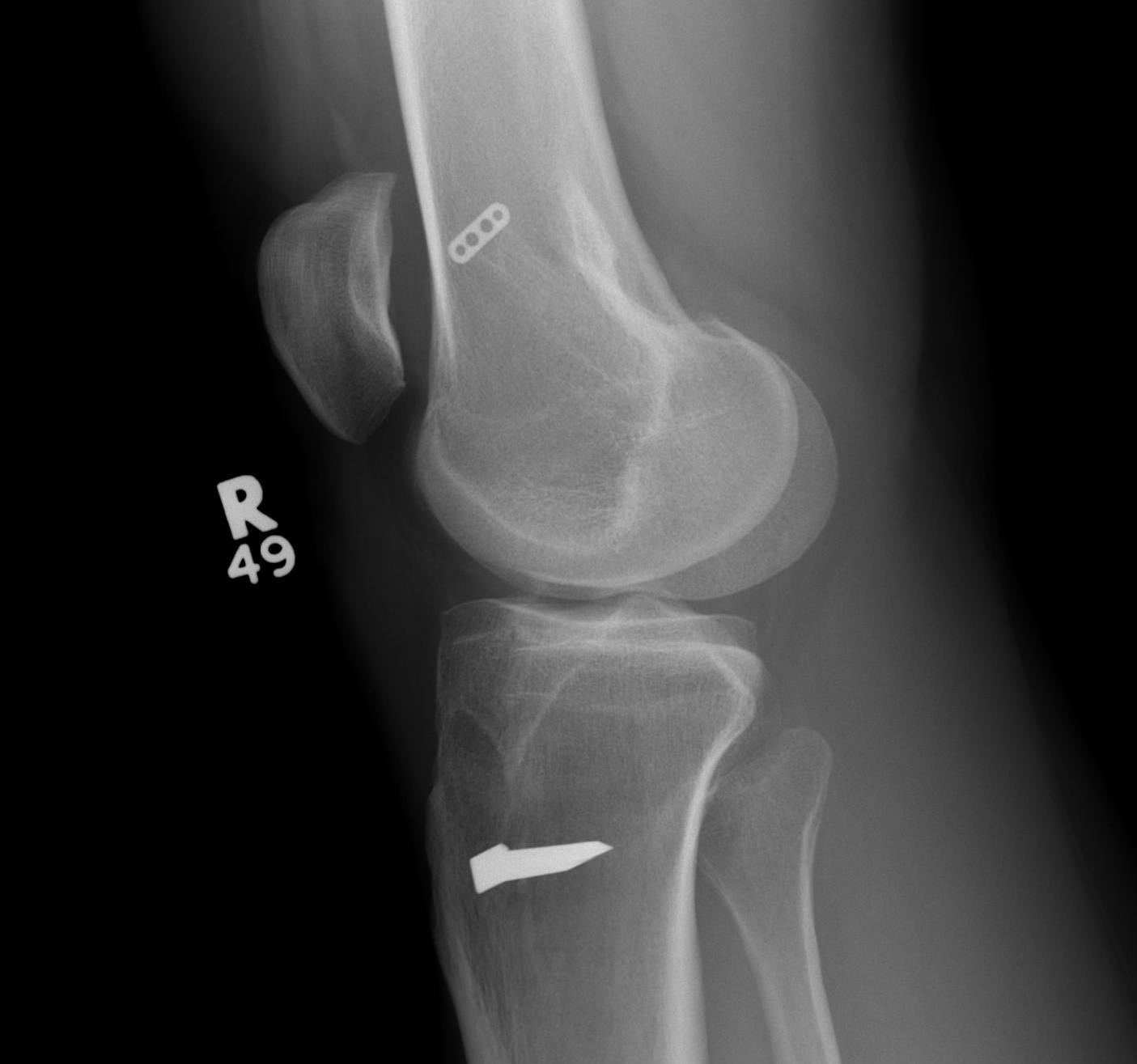 Revision ACL Pre Xray Lateral